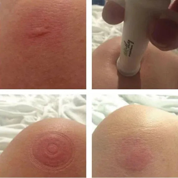Compact plastic Bug Bite Thing suction tool for insect bite relief