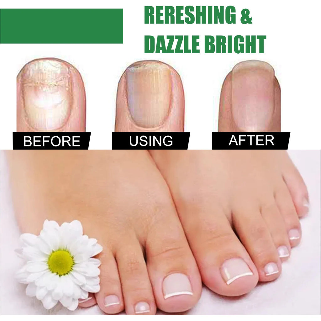 30ml bottle of tea tree oil foot and nail care repair fluid solution