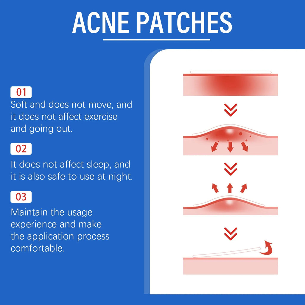 Pack of 216 round hydrocolloid acne patches for facial skincare with tea tree oil and vitamin E.